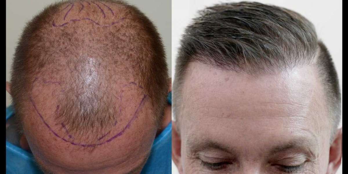 Fut Hair Transplant Results
