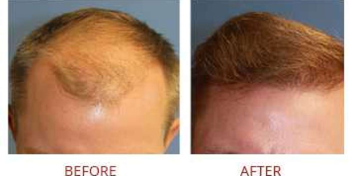 Revitalize Your Hair: FUE Treatment for Lasting Results