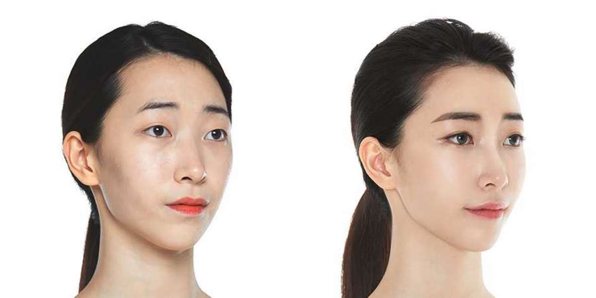 Considering Cosmetic Surgery in South Korea: A Guide to Informed Decision-Making
