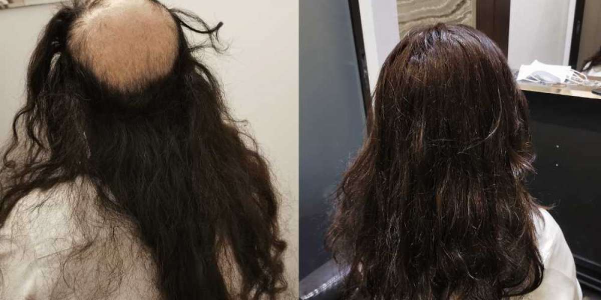 Hair transplant in singapore cost