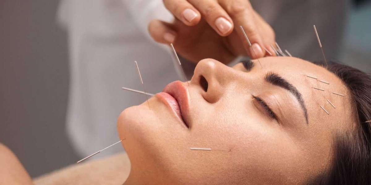 Elevate Your Energy Levels: Acupuncture for Fatigue
