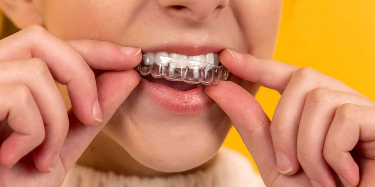 Factors Affecting the Cost and Complexity of Invisalign Treatment with an Orthodontist