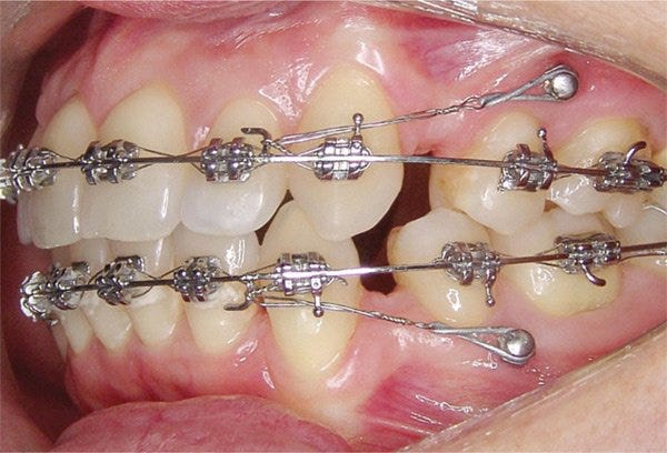Are Implants Considered Orthodontics? | by Magnolia Dental Service | May, 2024 | Medium