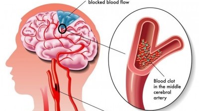 Best Neurology Hospital in Pune | Noble Hospitals