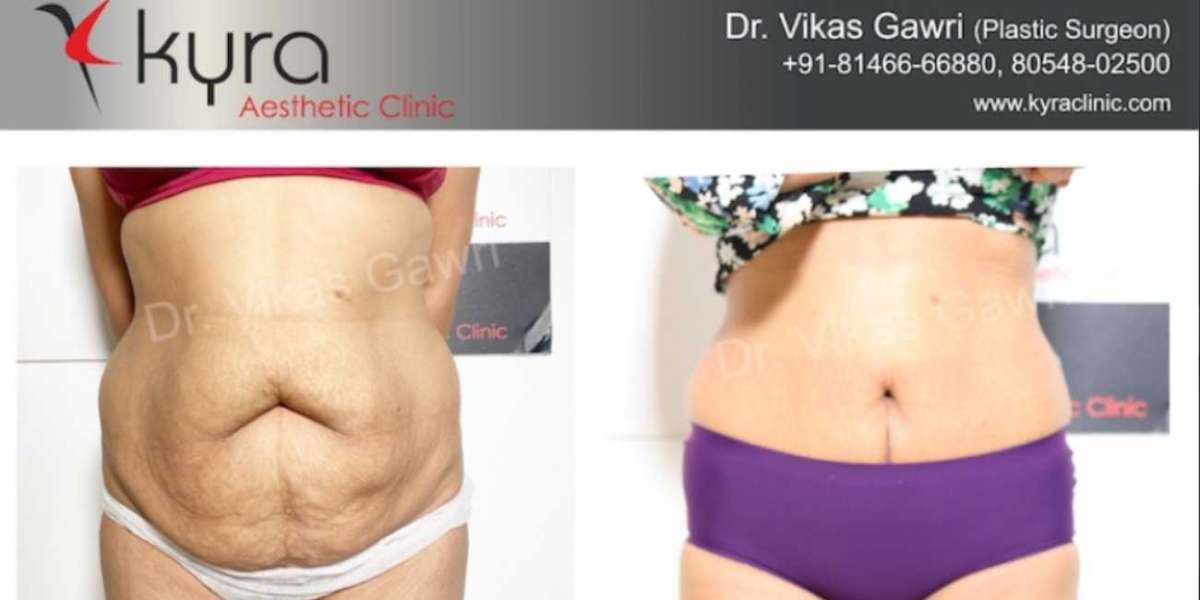 Transform Your Silhouette with Tummy Tuck Surgery in Ludhiana by Dr. Vikas Gawri