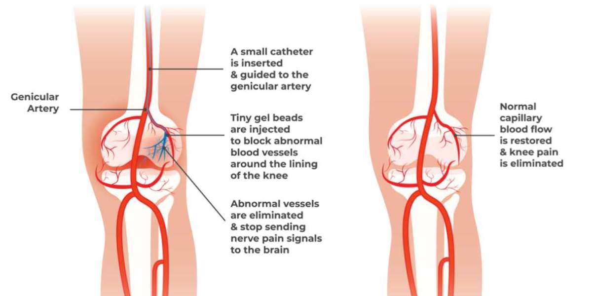 Genicular Artery Embolization: A Modern Solution for Knee Pain Relief