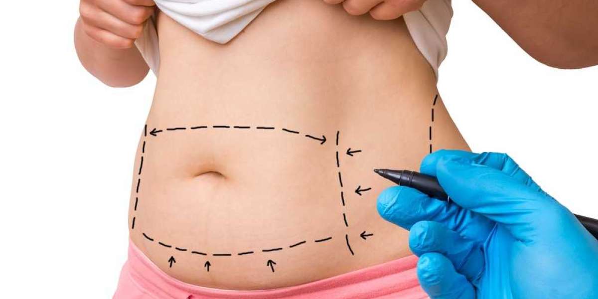 How to Dress for Your New Body After Tummy Tuck Surgery: Advice from the Best Doctors in Dubai